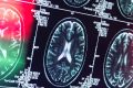 Alzheimer pourrait ne pas être une maladie du cerveau
