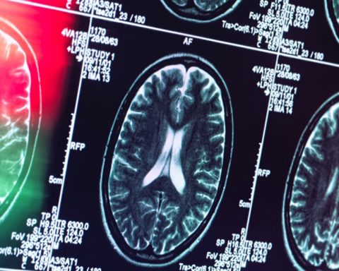 Alzheimer pourrait ne pas être une maladie du cerveau